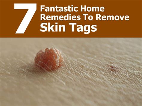 7 Fantastic Home Remedies To Remove Skin Tags