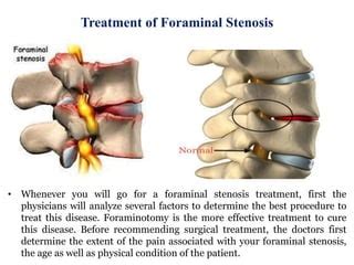 Treatment of foraminal stenosis