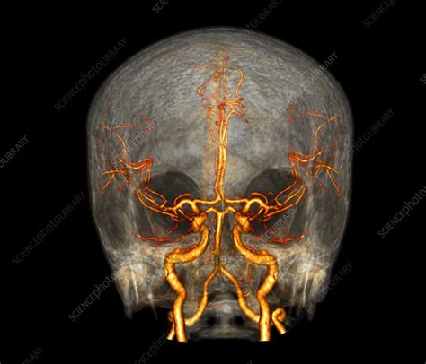 Brain and neck arteries, 3D CT angiogram - Stock Image - C038/8652 - Science Photo Library