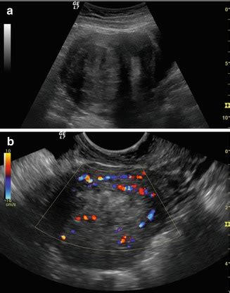 Complications of Myomectomy | Obgyn Key