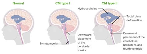 Chiari Malformations | Concise Medical Knowledge