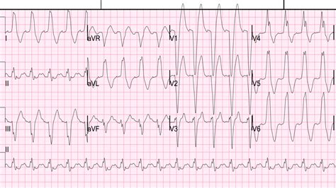 Dr. Smith's ECG Blog: Acute Pulmonary Edema, Respiratory Failure, and LBBB