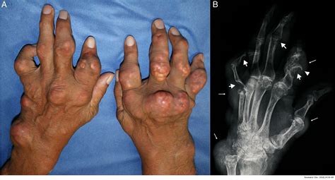 Is gout an easy-to-treat disease? The importance of health determinants | Reumatología Clínica