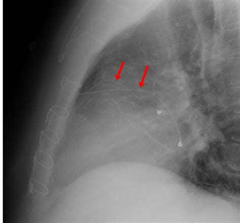 Epicardial pacing wires - Questions and Answers in MRI