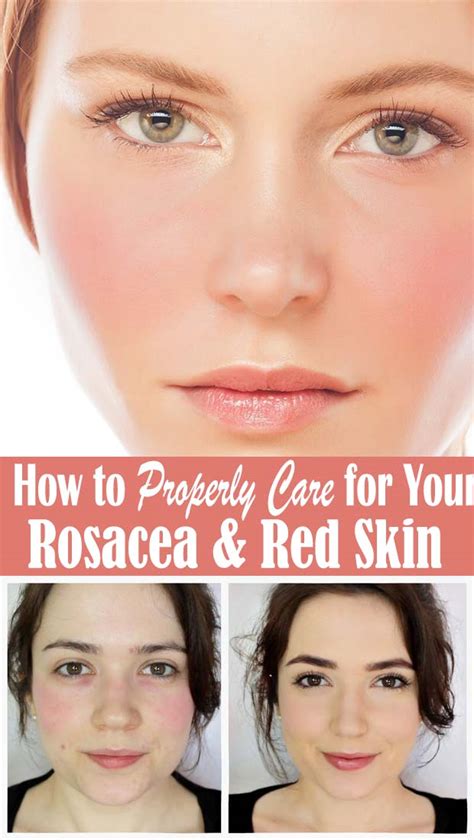 How to Properly Care for Your Rosacea & Red Skin - Healthy Lifestyle