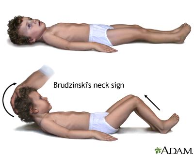 Brudzinski's sign of meningitis: MedlinePlus Medical Encyclopedia Image