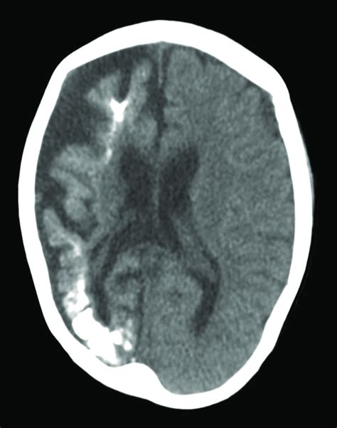 Brain computed tomography on admission reveals diffuse brain atrophy ...