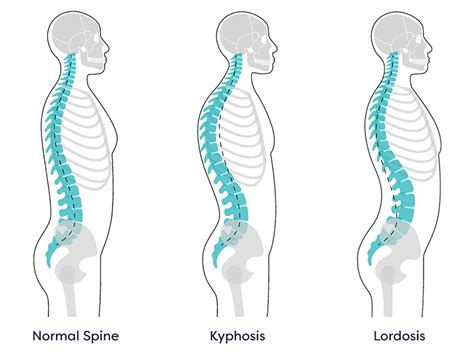 Kyphosis Treatment in NJ and NYC | Kyphosis Surgery in New Jersey