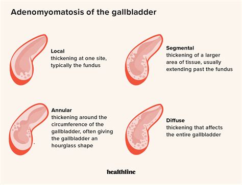 Adenomyomatosis Gallbladder