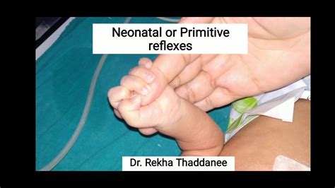 Neonatal Reflex | Palmar Grasp Reflex | Primitive Reflex | Pediatrics ...