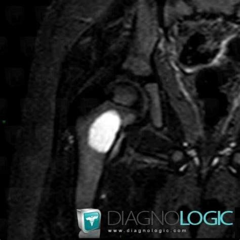 Radiology case : Simple bone cyst (MRI) - Diagnologic