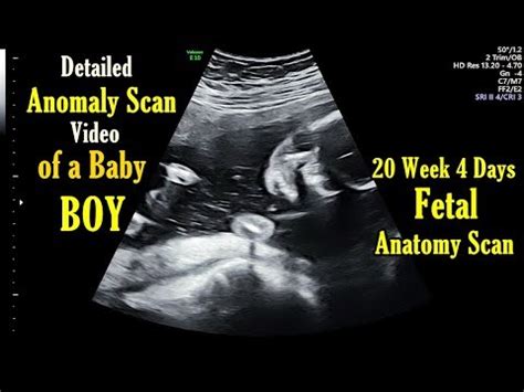 20 Week 4 Days Anomaly Scan in Pregnancy | Detailed Anatomy USG Scan of Baby Boy - YouTube