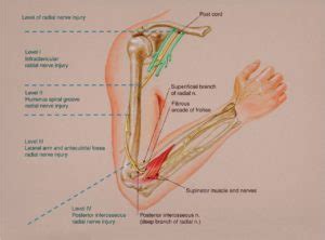 Radial Nerve Injury | Hand2Shoulder Clinic