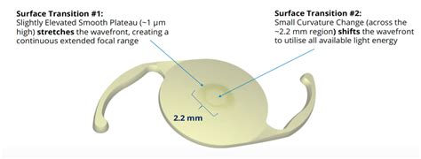 Alcon Vivity Lens implant - Tanner Eyes