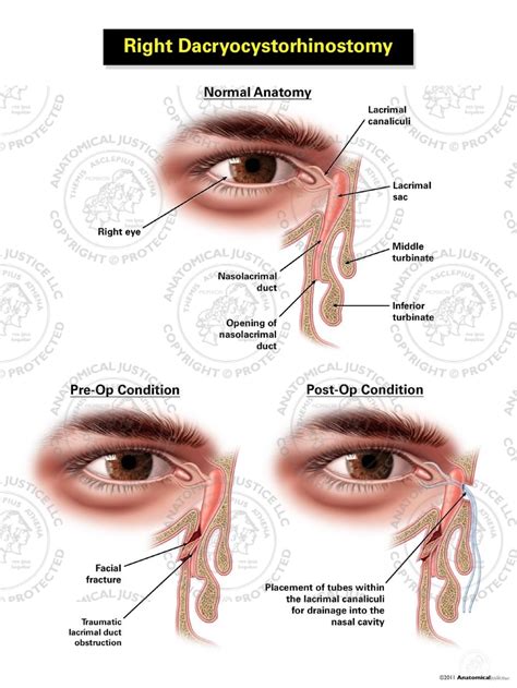 Right Dacryocystorhinostomy