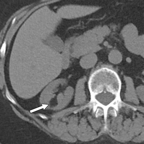 Fat-containing Retroperitoneal Lesions: Imaging Characteristics, Localization, and Differential ...