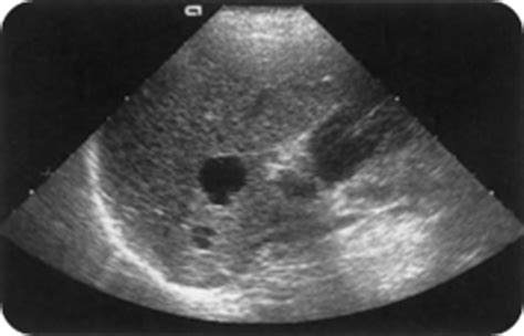 Ultrasound images Simple cysts - Radiology Imaging