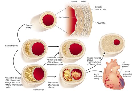 Atherosclerosis