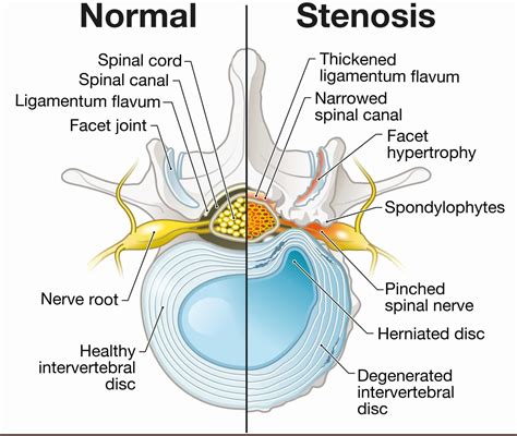 Central Canal Stenosis: Definition - Spine Info