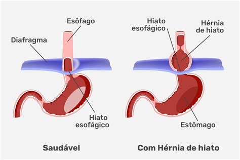 Hérnia de hiato: o que é, sintomas e quando fazer cirurgia - Tua Saúde