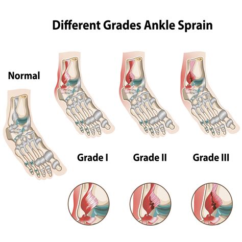 Laser Therapy for Ankle Sprain — Chiropractor Nashville, TN ...