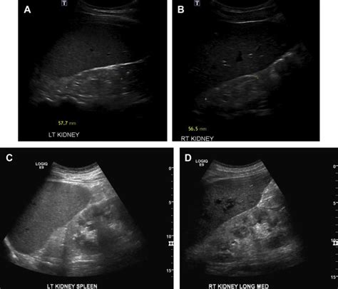 Imaging of Acute Renal Failure in the Hospital Setting | Radiology Key