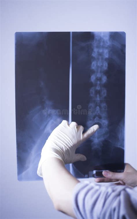 Medical Xray Spine Hip Scan Stock Photo - Image of dislocation ...