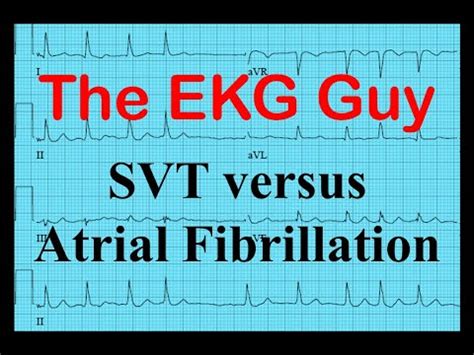 Unterschied zwischen AFIB und VFIB und SVT | Vergleichen Sie den Unterschied zwischen ähnlichen ...