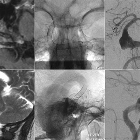 5a-i Reconstructive approach for vertebrobasilar (VB) dolichoectasia.... | Download Scientific ...