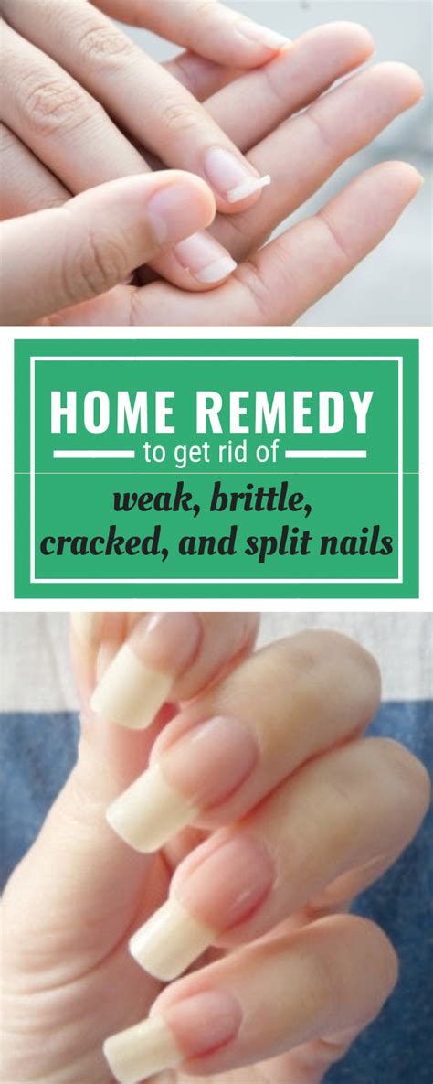 Best Home Remedy To Get Rid Of Weak, Brittle, Cracked And Split Nails # ...