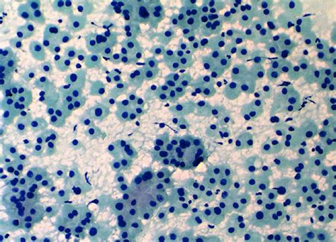 Pathology Outlines - Follicular neoplasm