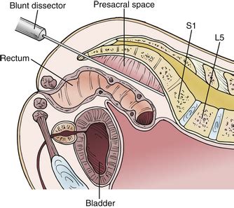 Paracoccygeal Transsacral Approach to the Lumbosacral Junction for ...