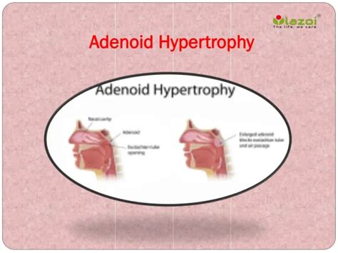 PPT - Adenoid hypertrophy Causes, Symptoms, Diagnosis, Prevention Treatment in India PowerPoint ...