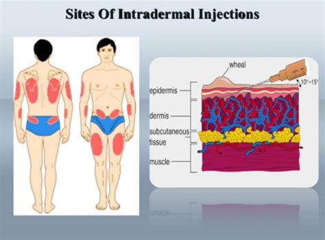 Injection Sites Flashcards | Quizlet