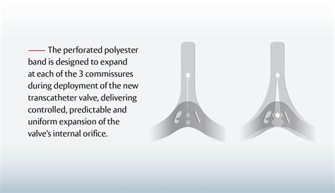 INSPIRIS RESILIA Aortic Valve | Edwards Lifesciences | Aortic valve replacement, Heart valves ...