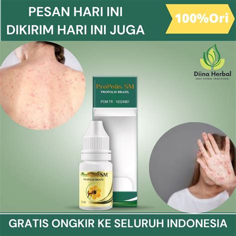 Jual Obat Campak, Obat Penghilang Bekas Campak, Obat Campak Untuk Anak Dan Dewasa, Obat Campak ...