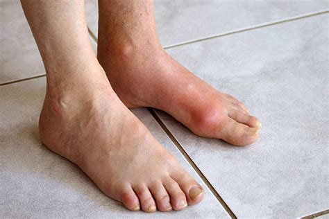 Bệnh Gout: Nguyên nhân, Triệu chứng, Cách điều trị