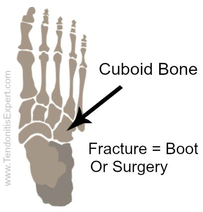 Cuboid Fracture