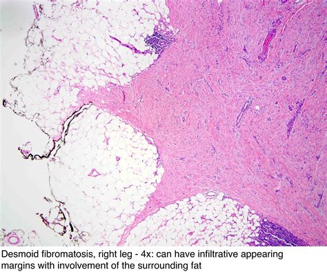 Pathology Outlines - Fibromatosis-desmoid