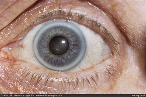 STOCK IMAGE, close-up of an eye with arcus senilis a gray or white opaque arc around the cornea ...