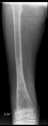 Chronic osteomyelitis | Radiology Reference Article | Radiopaedia.org