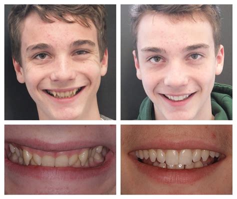 Teeth Whitening Before And After - Houston, TX Patch