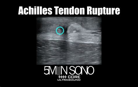 Achilles Tendon Rupture – Core Ultrasound