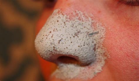 10 Top Home Remedies To Get Rid of Blackheads