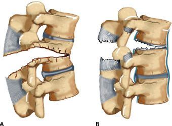 Thoracolumbar Spine Fractures and Dislocations | Musculoskeletal Key