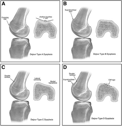 Dejour classification system for trochlear dysplasia represented by ...