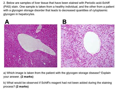 [Solved]: 2. Below are samples of liver tissue that have b