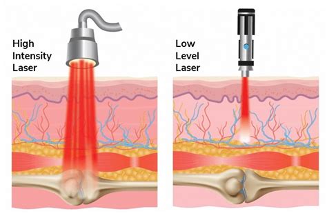 Introducing High-Intensity Laser Therapy at CoachAmyPT — CoachAmyPT