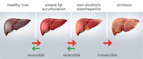 Non-alcoholic fatty liver disease, Genes and Diet