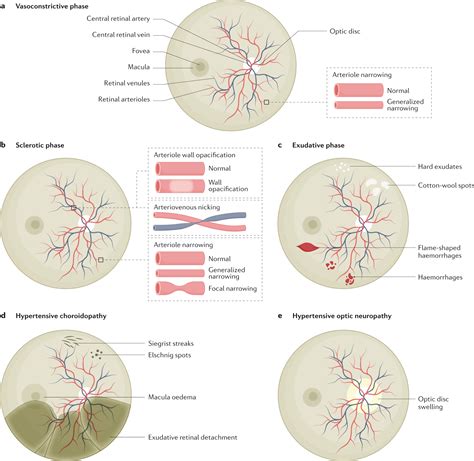 What Are the Stages of Hypertensive Retinopathy? - Low Vision Aids